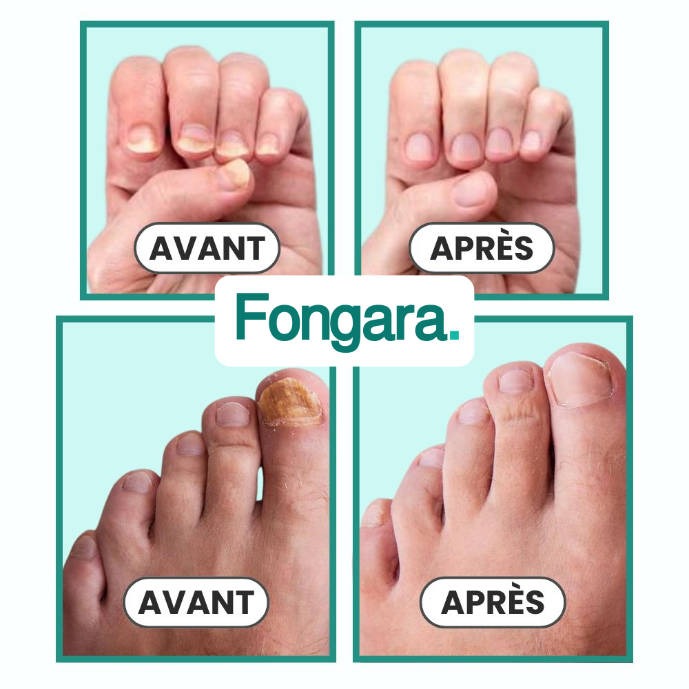 Pack Fongara™ — Élimine la Mycose des Ongles en 7 Minutes / Jour