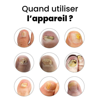 Pack Fongara™ — Élimine la Mycose des Ongles en 7 Minutes / Jour